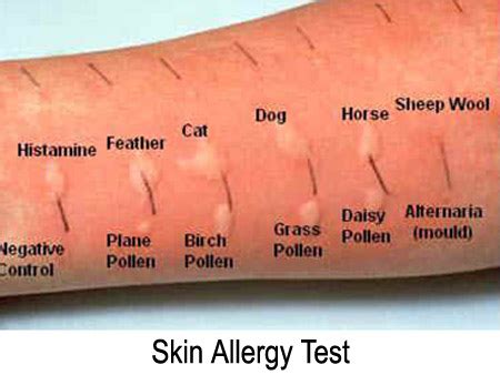 scratch test allergy toddler|allergic reaction testing for children.